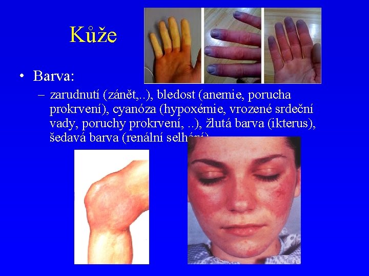 Kůže • Barva: – zarudnutí (zánět, . . ), bledost (anemie, porucha prokrvení), cyanóza