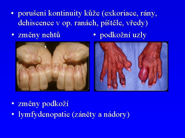  • porušení kontinuity kůže (exkoriace, rány, dehiscence v op. ranách, píštěle, vředy) •