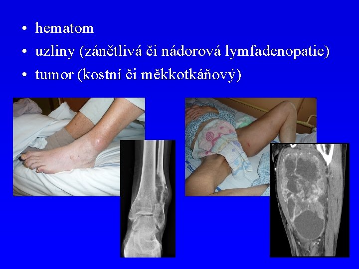  • hematom • uzliny (zánětlivá či nádorová lymfadenopatie) • tumor (kostní či měkkotkáňový)