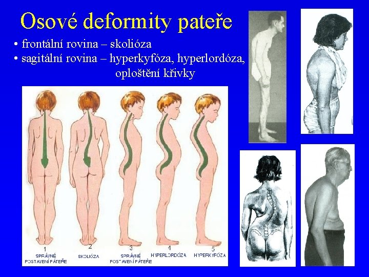 Osové deformity pateře • frontální rovina – skolióza • sagitální rovina – hyperkyfóza, hyperlordóza,