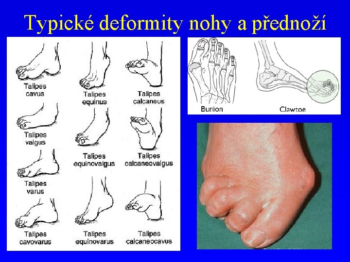 Typické deformity nohy a přednoží 