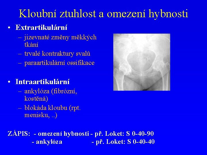 Kloubní ztuhlost a omezení hybnosti • Extrartikulární – jizevnaté změny měkkých tkání – trvalé