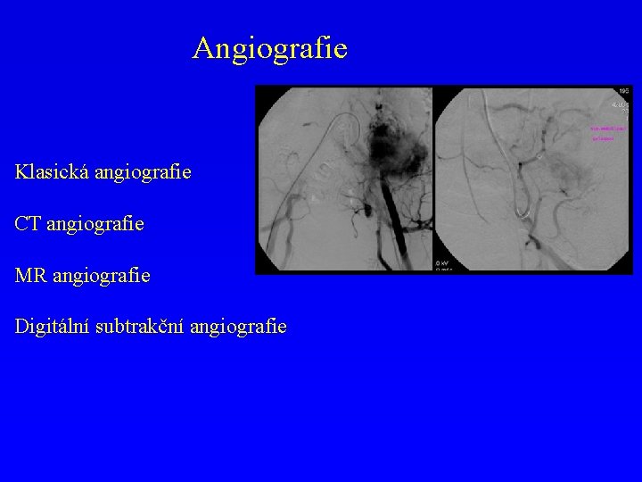 Angiografie Klasická angiografie CT angiografie MR angiografie Digitální subtrakční angiografie 