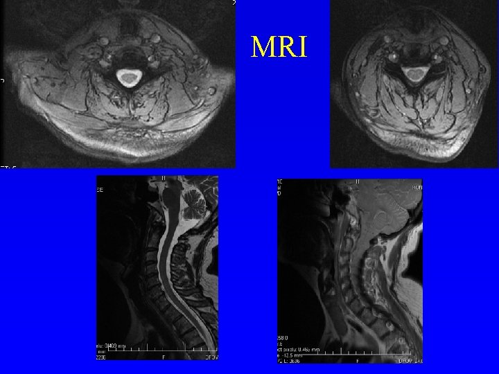 MRI 