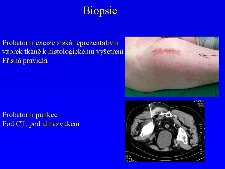 Biopsie Probatorní excize získá reprezentativní vzorek tkáně k histologickému vyšetření Přísná pravidla Probatorní punkce