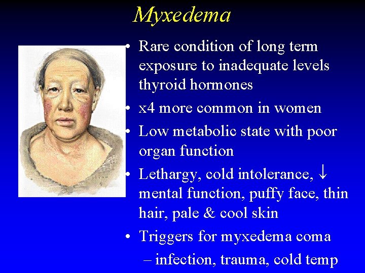 Myxedema • Rare condition of long term exposure to inadequate levels thyroid hormones • Myxedema • Rare condition of long term exposure to inadequate levels thyroid hormones •
