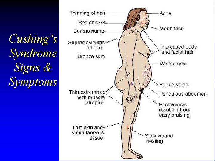 Cushing’s Syndrome Signs & Symptoms Cushing’s Syndrome Signs & Symptoms
