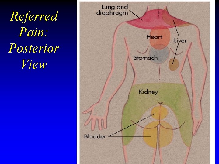 Referred Pain: Posterior View Referred Pain: Posterior View