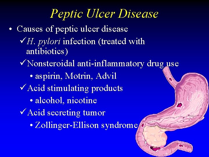 Peptic Ulcer Disease • Causes of peptic ulcer disease üH. pylori infection (treated with Peptic Ulcer Disease • Causes of peptic ulcer disease üH. pylori infection (treated with