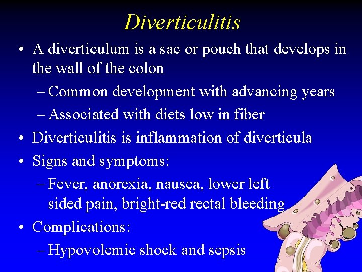 Diverticulitis • A diverticulum is a sac or pouch that develops in the wall Diverticulitis • A diverticulum is a sac or pouch that develops in the wall