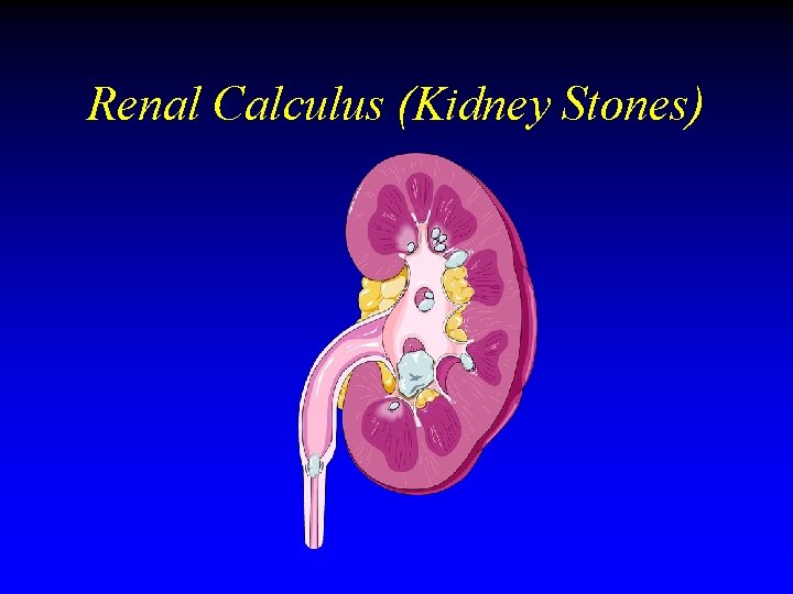 Renal Calculus (Kidney Stones) Renal Calculus (Kidney Stones)