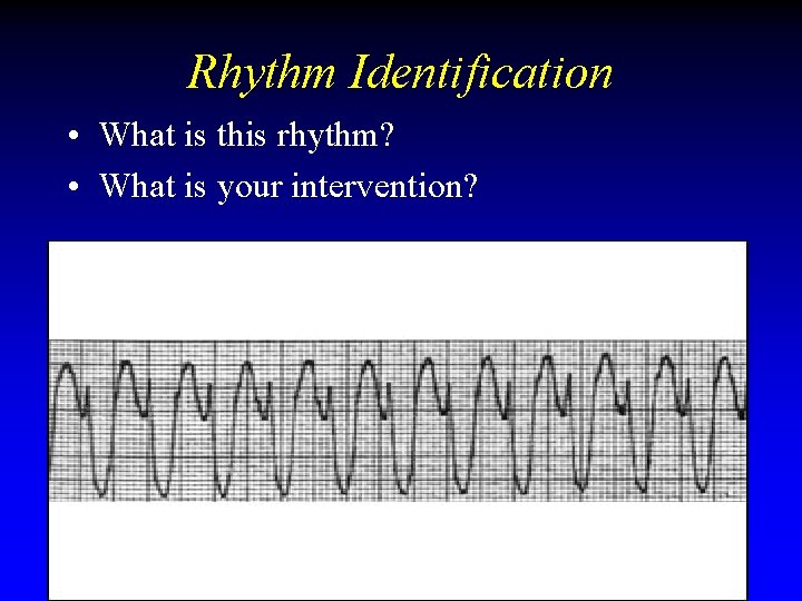 Rhythm Identification • What is this rhythm? • What is your intervention? Rhythm Identification • What is this rhythm? • What is your intervention?