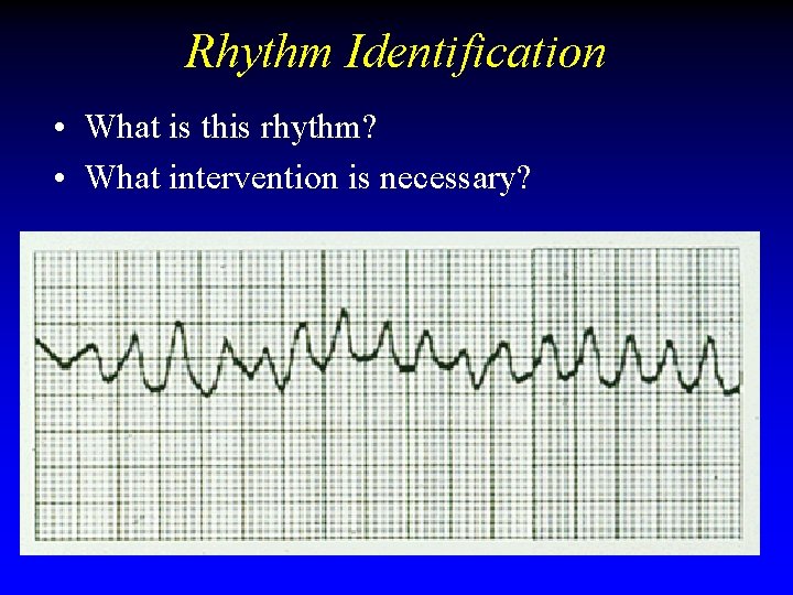 Rhythm Identification • What is this rhythm? • What intervention is necessary? Rhythm Identification • What is this rhythm? • What intervention is necessary?
