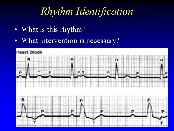 Rhythm Identification • What is this rhythm? • What intervention is necessary? Rhythm Identification • What is this rhythm? • What intervention is necessary?