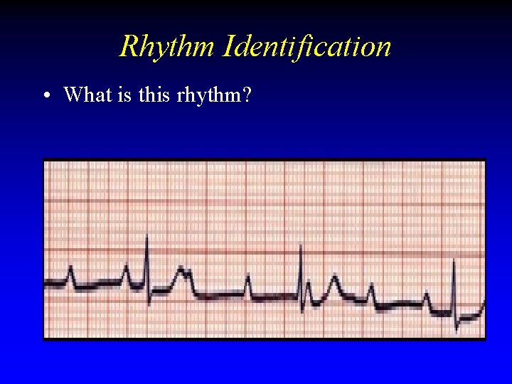 Rhythm Identification • What is this rhythm? Rhythm Identification • What is this rhythm?
