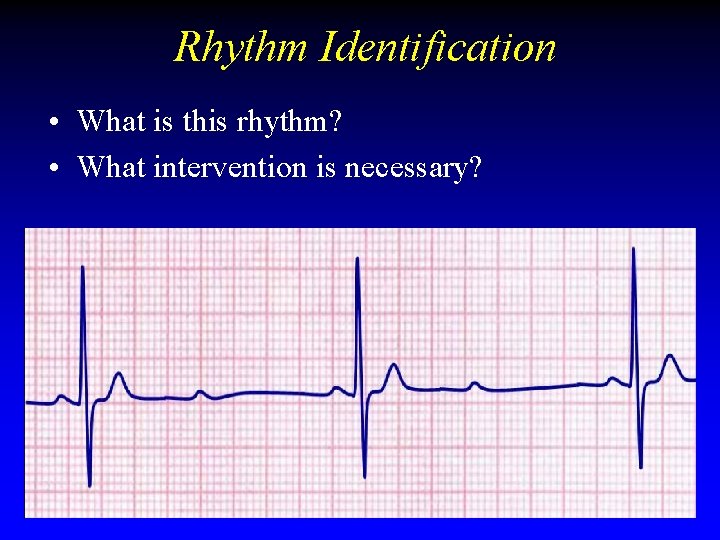 Rhythm Identification • What is this rhythm? • What intervention is necessary? Rhythm Identification • What is this rhythm? • What intervention is necessary?