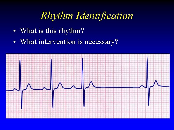 Rhythm Identification • What is this rhythm? • What intervention is necessary? Rhythm Identification • What is this rhythm? • What intervention is necessary?