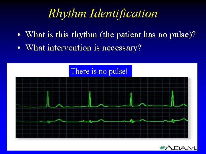 Rhythm Identification • What is this rhythm (the patient has no pulse)? • What Rhythm Identification • What is this rhythm (the patient has no pulse)? • What
