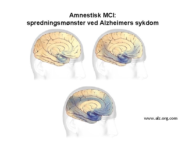 Amnestisk MCI: spredningsmønster ved Alzheimers sykdom www. alz. org. com 