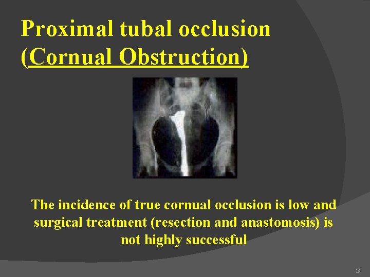 Proximal tubal occlusion (Cornual Obstruction) The incidence of true cornual occlusion is low and