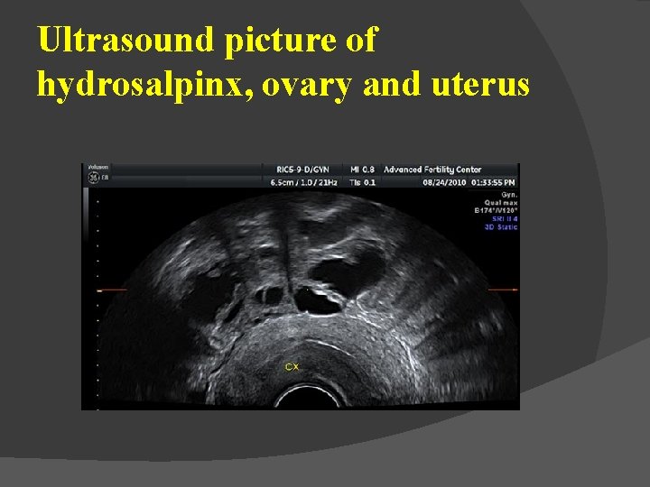 Ultrasound picture of hydrosalpinx, ovary and uterus 