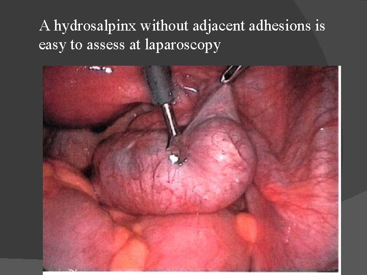 A hydrosalpinx without adjacent adhesions is easy to assess at laparoscopy 