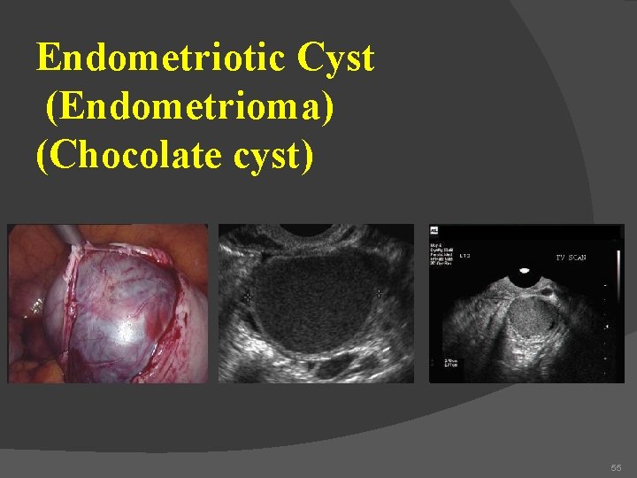 Endometriotic Cyst (Endometrioma) (Chocolate cyst) 55 