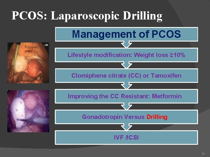 PCOS: Laparoscopic Drilling Management of PCOS Lifestyle modification: Weight loss ≥ 10% Clomiphene citrate