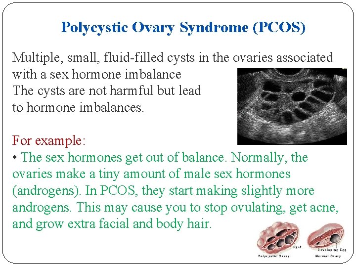 Polycystic Ovary Syndrome (PCOS) Multiple, small, fluid-filled cysts in the ovaries associated with a