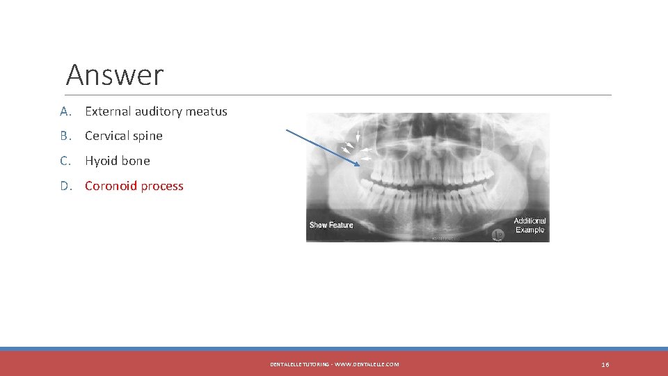 Answer A. External auditory meatus B. Cervical spine C. Hyoid bone D. Coronoid process