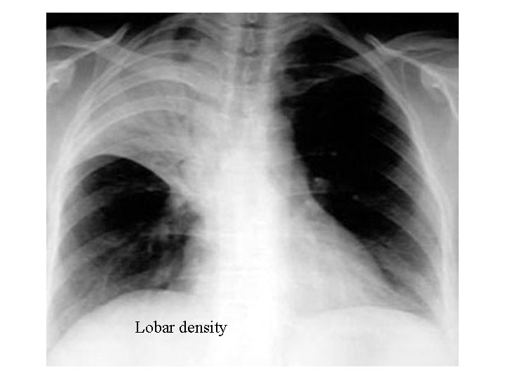 Lobar density 