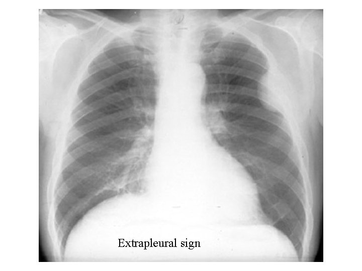 Extrapleural sign 