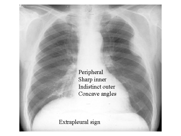 Peripheral Sharp inner Indistinct outer Concave angles Extrapleural sign 