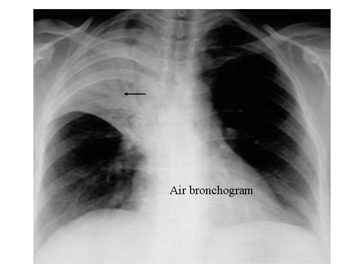 Air bronchogram 