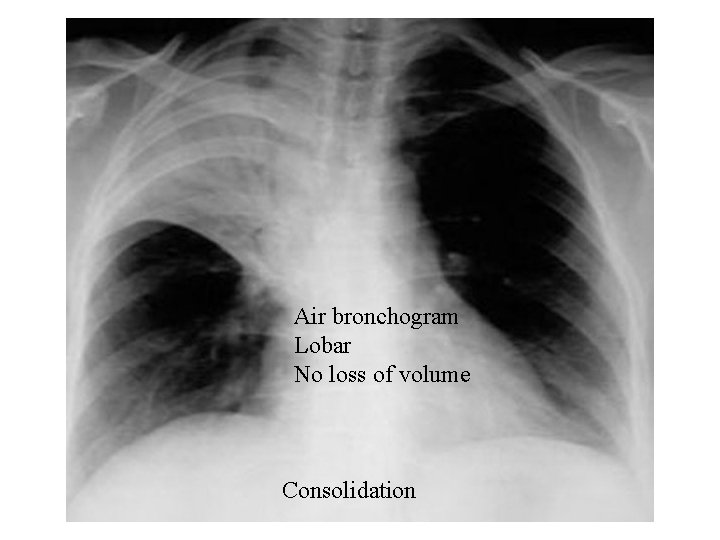 Air bronchogram Lobar No loss of volume Consolidation 