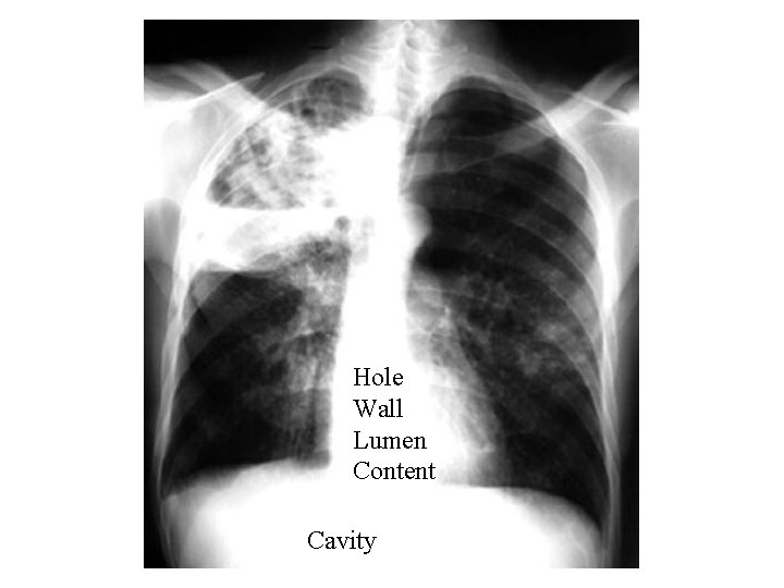 Hole Wall Lumen Content Cavity 