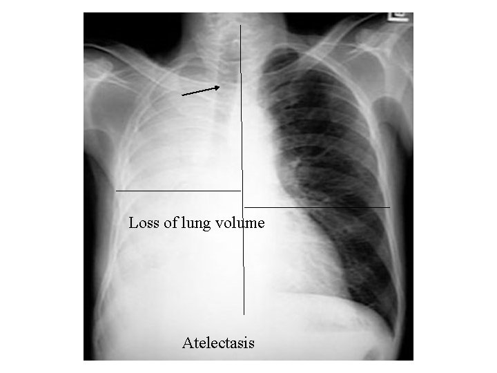 Loss of lung volume Atelectasis 