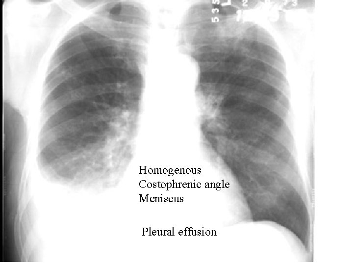 Homogenous Costophrenic angle Meniscus Pleural effusion 