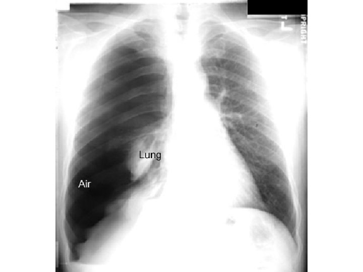 Pneumothorax 