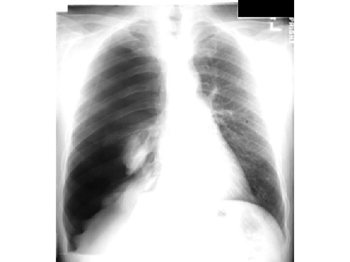 Air in pleura Atelectatic lung Hemithorax Mediastinual shift Pneumothorax 