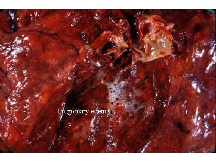 Pulmonary edema 