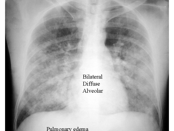 Bilateral Diffuse Alveolar 