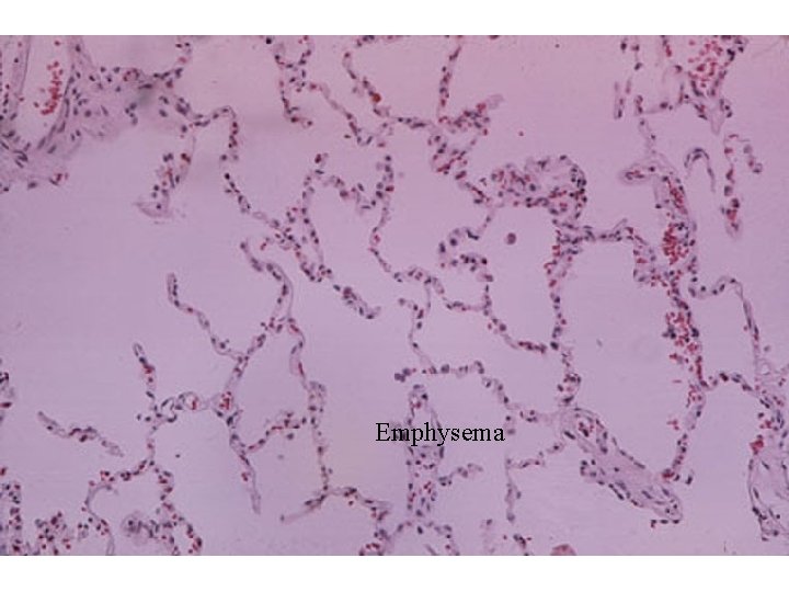 Emphysema 