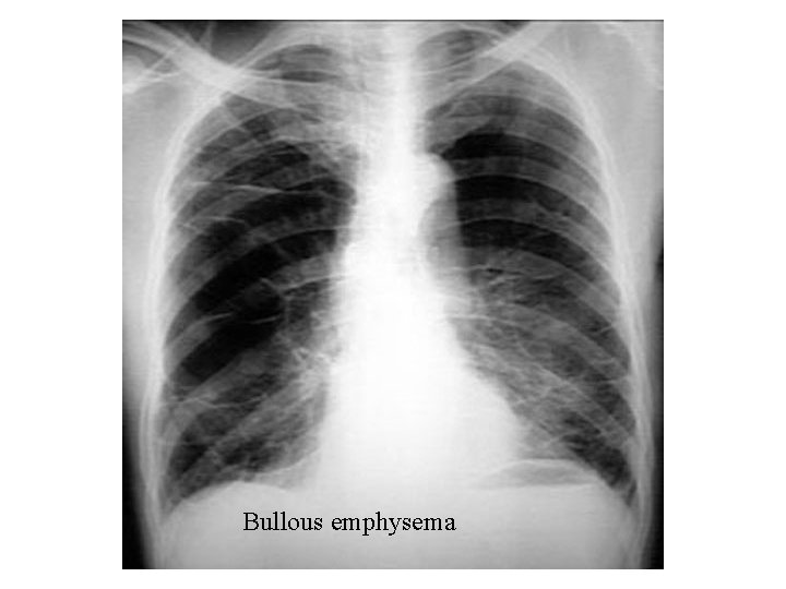 Bullous emphysema 