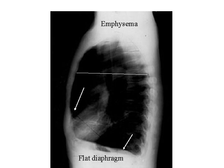 Emphysema Flat diaphragm 