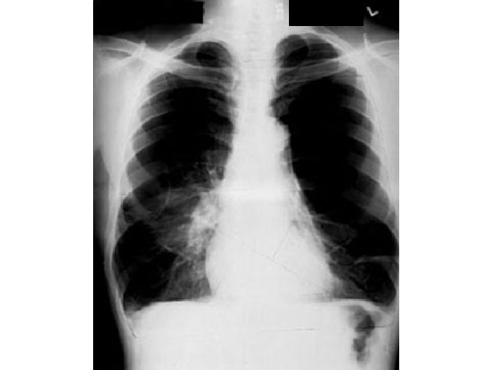 Dark lungs AP diameter Low flat diaphragms Vertical heart Retrosternal air Infracardiac air Avascularity