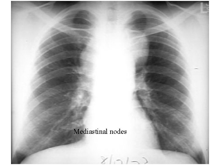 Mediastinal nodes 