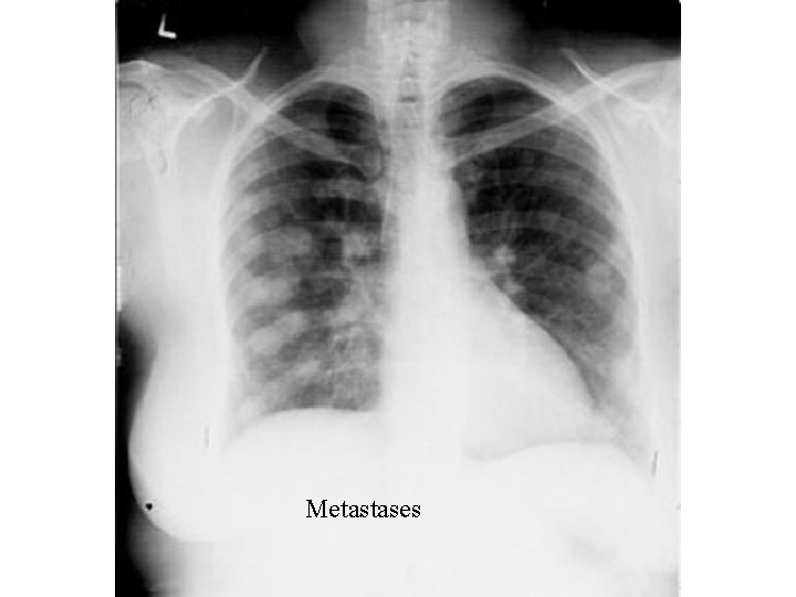 Metastases 