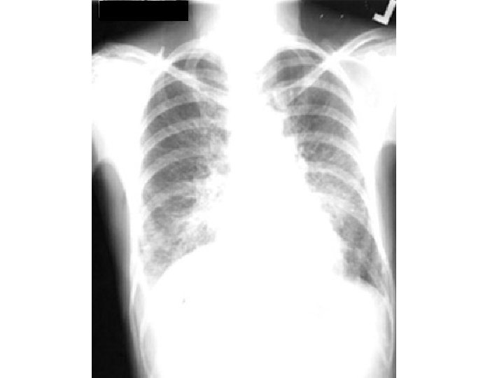 Diffuse interstitial 