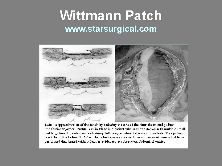Wittmann Patch www. starsurgical. com 